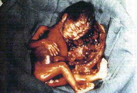 Aborto