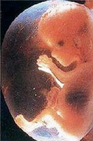 Aborto - contra la vida